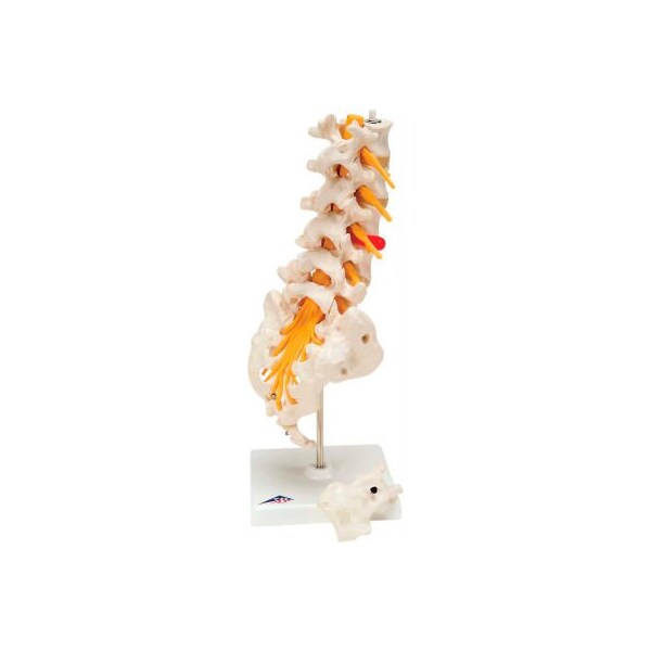 3B Anatomical Model - Lumbar Spinal Column with Dorso-Lateral Prolapsed Disc